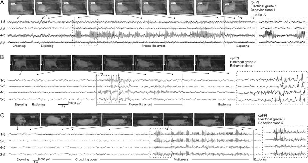 Curia 1584 Posttraumatic Epilepsy Variants d et al. Figure 6. ECoG traces and video frames of chronic seizures induced by FPI. (A) A ~42s-long G1 seizure with behavioral arrest following 3.