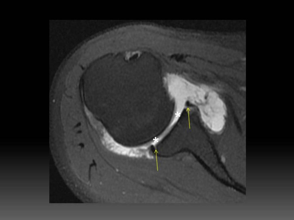 Fig. 5: Anterior and posterior glenoid chondral defects. T1 fat sat axial MRA image.