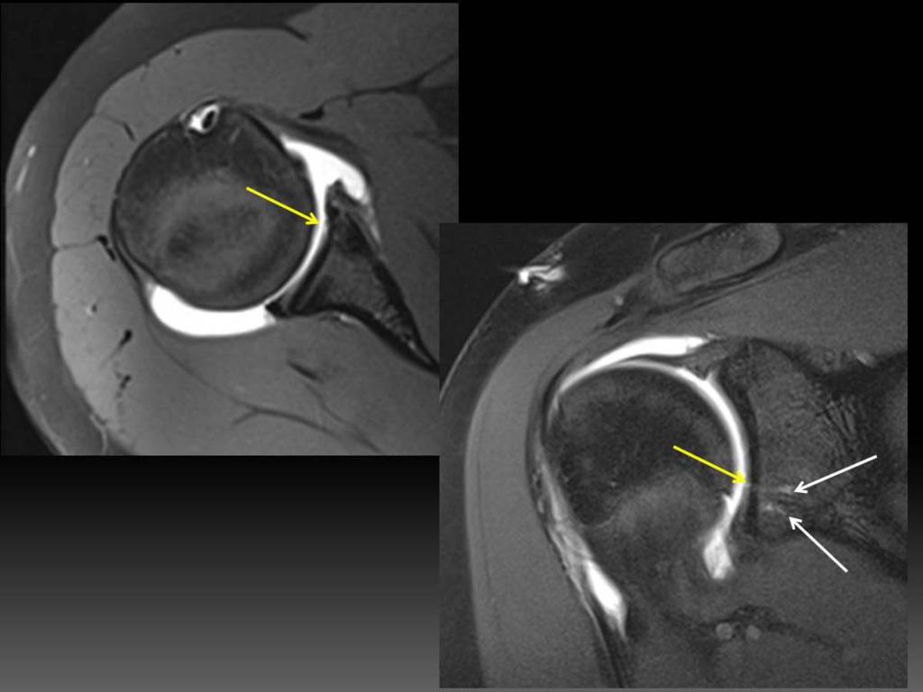 Fig. 9: Post operative changes. T1 fat sat axial and cor oblique MRA images in a patient with previous anterior labral repair.