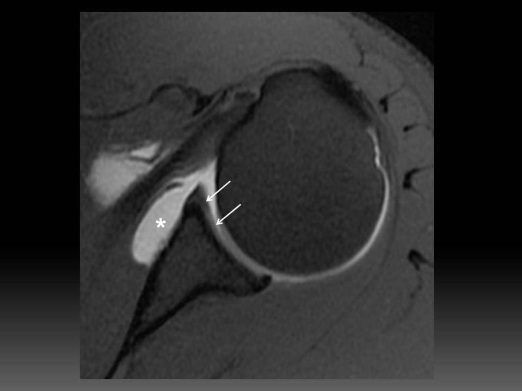It is unknown whether this abnormal glenoid contour was an underlying causative factor in his instability or whether it reflects modelling deformity in response to instability in this case.