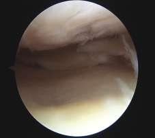 Meniscus Tears When to Scope RTP