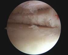 Partial meniscectomy / debridement