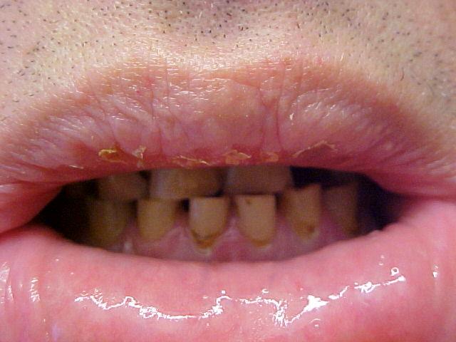 ROS reveals poor dentition