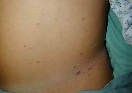 Case 7: Fever and Rash College student