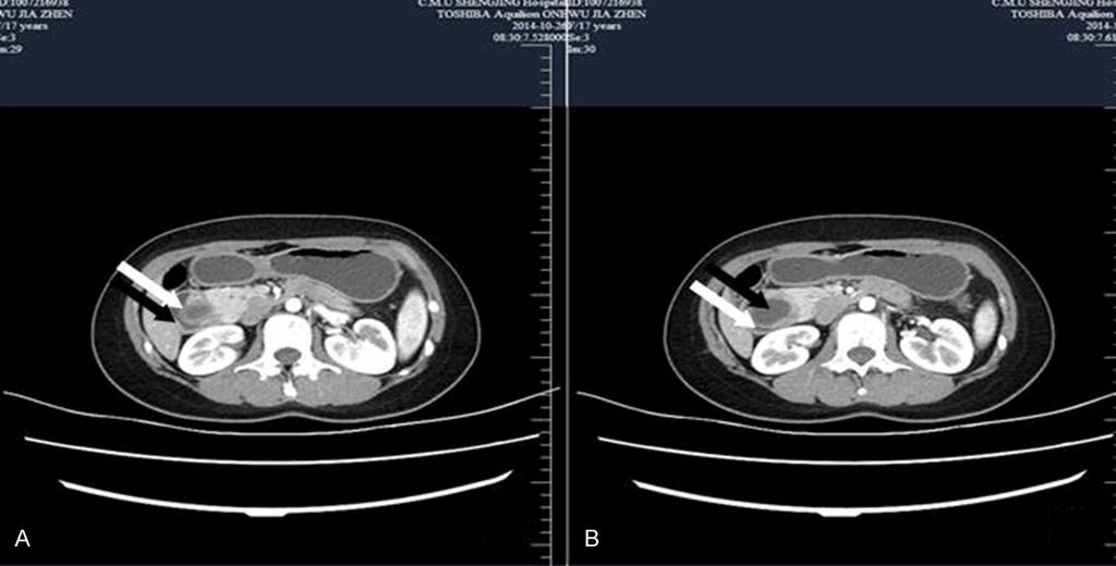 Figure 2. Upon abdominal contrast-enhanced computerized tomography, a cystic lesion of 3.4 3.