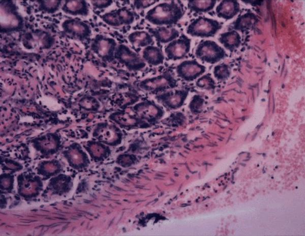 Histological findings revealed that duodenum-like mucosa, submucosa and muscle coats were found from the resected tissue. Figure 7.