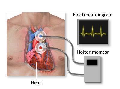 Monitors Holter monitor 24 hour ECG recording Tetralogy of Fallot Hypoplastic left heart
