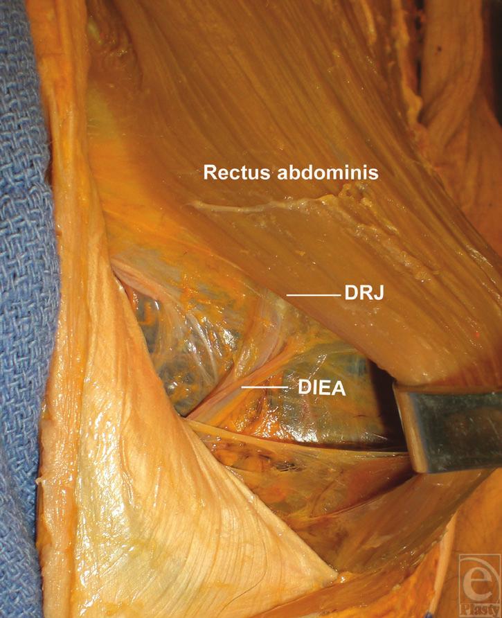 eplasty VOLUME 10 Figure 1. A dissection of the rectus muscle, the deep inferior epigastric artery (DIEA) rectus junction (DRJ), and the DIEA.