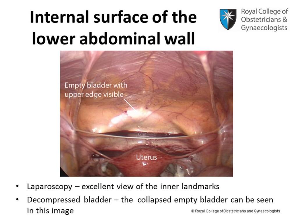 The parietal peritoneal surface, which is the last layer of the anterior abdominal wall, is best seen during a laparoscopy as this gives an excellent view of the inner landmarks.
