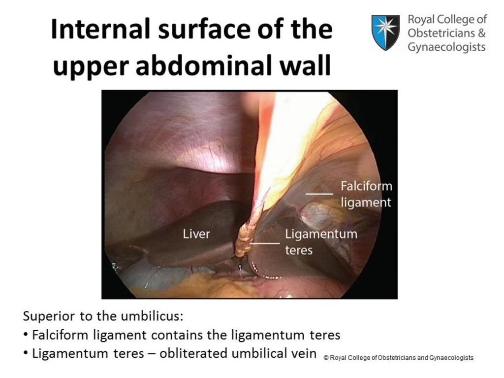 Superior to the umbilicus, a median fold known as the falciform ligament contains the ligamentum teres which is the remnant of the obliterated umbilical vein in its free