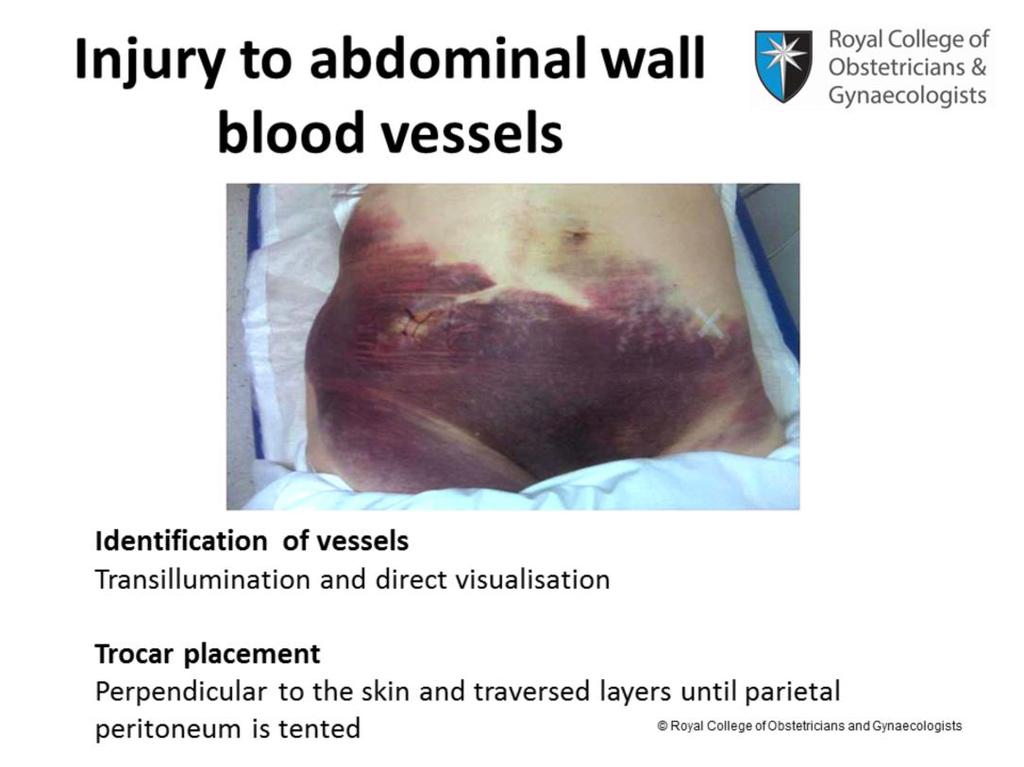 The picture in this slide shows extensive bruising as a result of injury to an anterior abdominal wall vessel during placement of lateral laparoscopic ports.