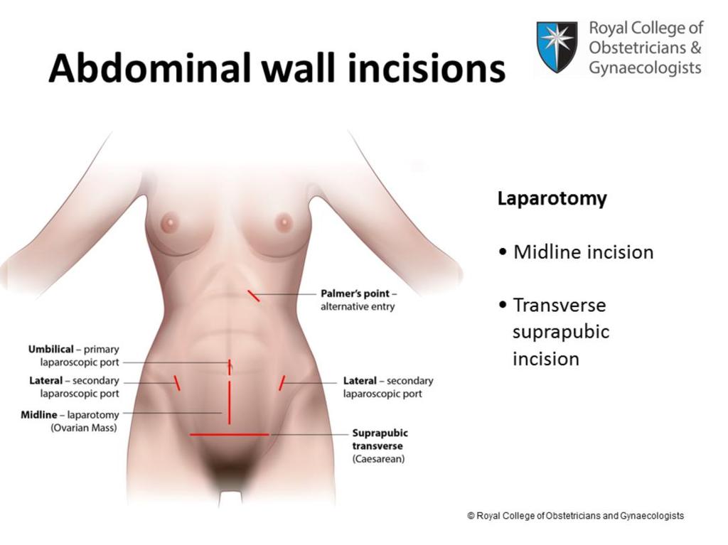 In these last two slides we will look briefly at the common anterior abdominal wall incisions made during laparotomy and laparoscopy.