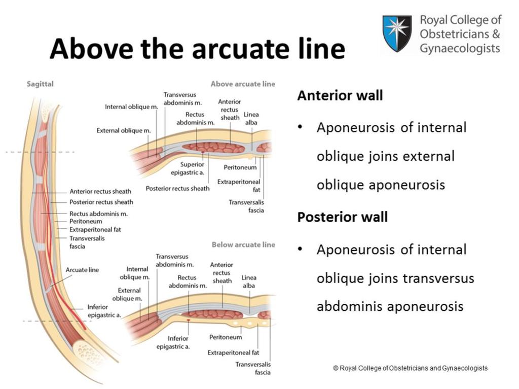 The internal oblique muscle is sandwiched between the external oblique and transversus abdominis muscles. The aponeurosis of the internal oblique muscle is bilaminar.