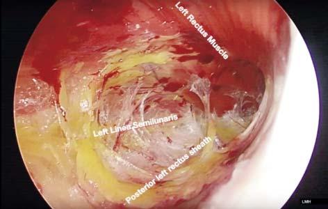 Retromuscular Approach in Ventral Hernia Repair - Endoscopic Rives-Stoppa Procedure procedure (etep approach): restauration of linea alba and placing a large polypropylene mesh into the retrorectus