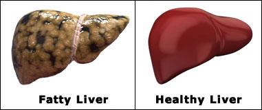 Fatty Liver 47 1.