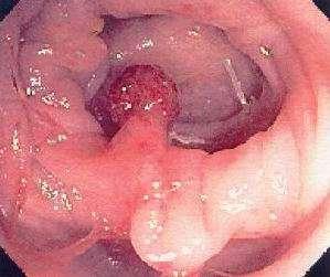 Why is colorectal cancer preventable Adenoma - Carcinoma Sequence Most colorectal cancers start as benign polyps