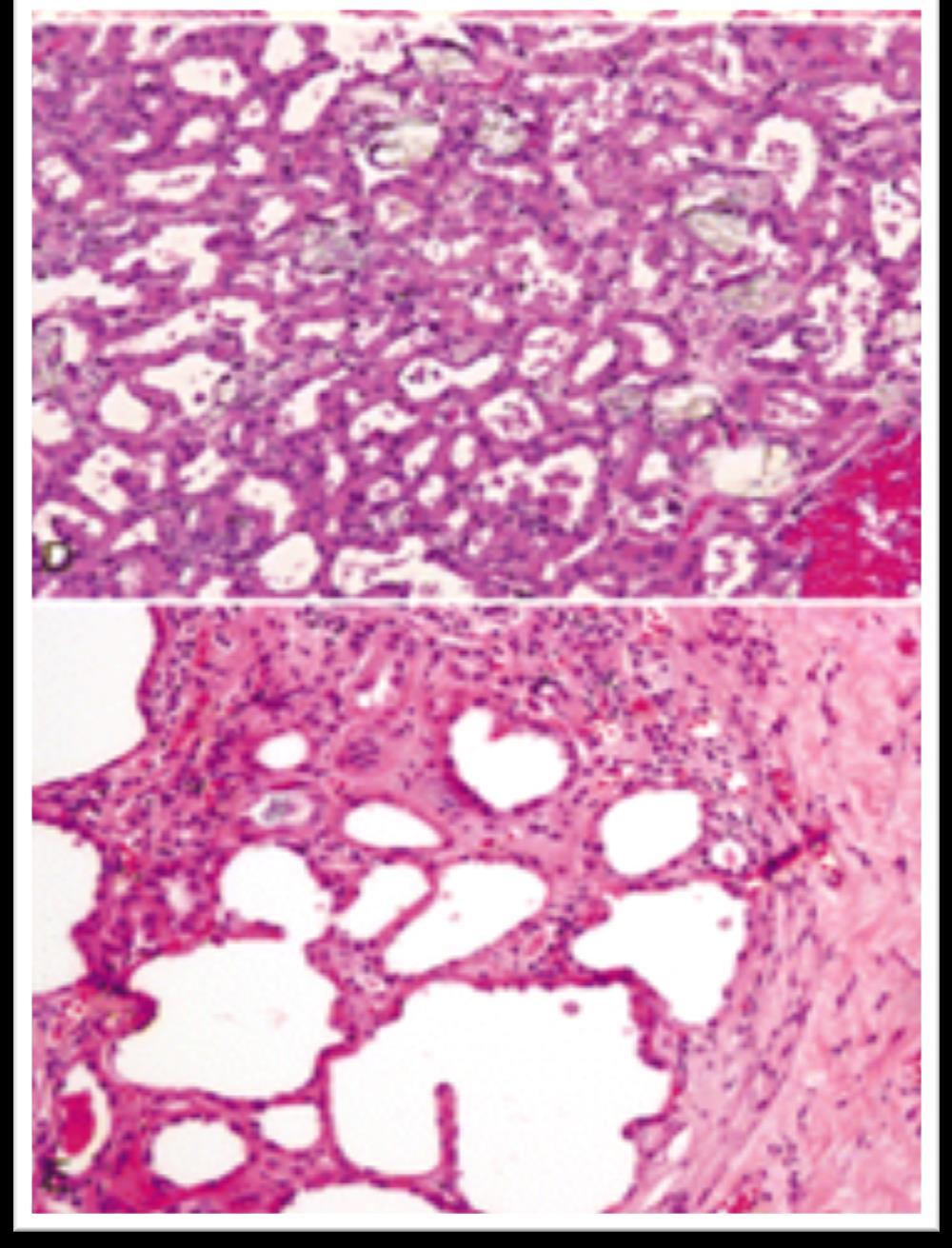 Microscopically: tumors show various combinations of acinar, solid alveolar, microcystic or macrocystic, and papillary architectural patterns.