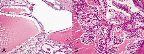 A, Clear cell papillary RCC often contains cystic areas. B, Intracystic papillary architectural pattern is common.