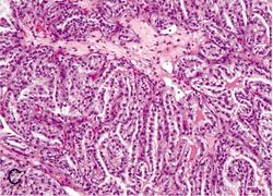 Clear cell papillary RCC the tumor contains tightly packed papillae and tubules,