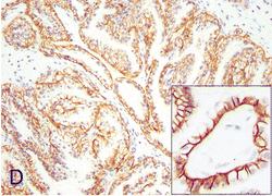 Clear cell papillary RCC Immunohistochemically stain for carbonic anhydrase IX shows a diffuse membranous