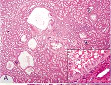 TSC with scattered, small cysts, separated by otherwise unremarkable intervening renal parenchyma.