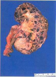 Renal cell carcinoma developing in