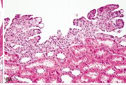 The lining in some sporadic, unilocular or multilocular cysts may show