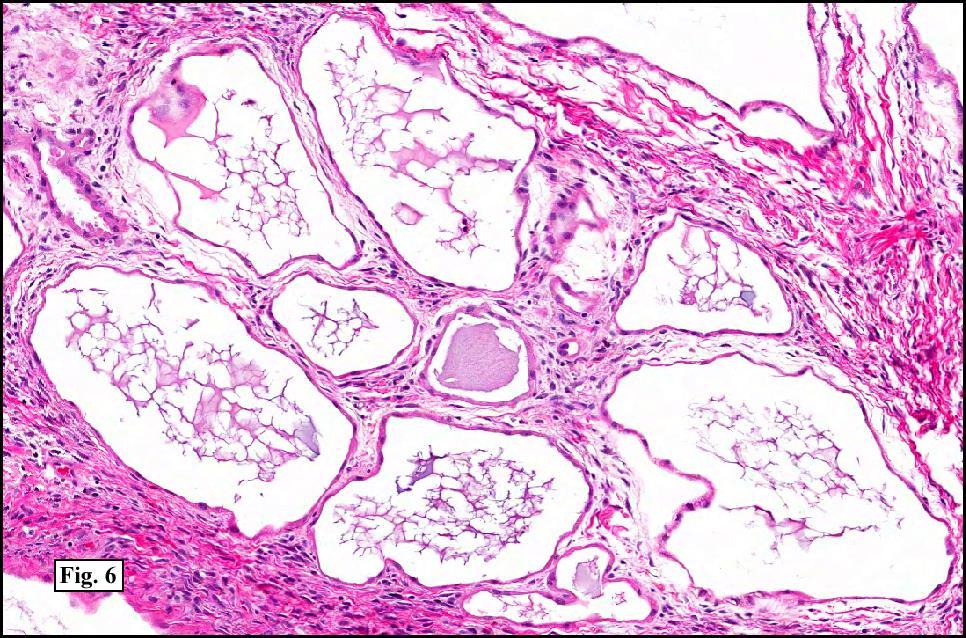 Microscopically: its showing multiple cysts lined by flattened epithelium