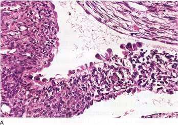 A and B, Multicystic nephroma. A, The epithelial lining of the cyst has a hobnail quality.