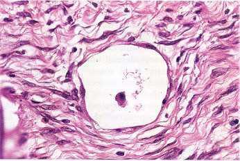 A few cases of multicystic nephroma have been reported in adult patients to contain clusters of