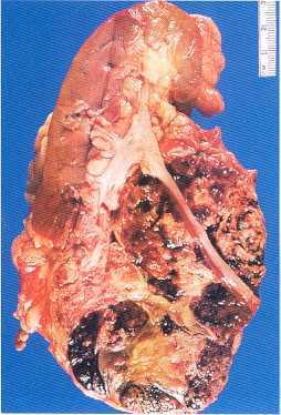 Gross appearances of renal cell