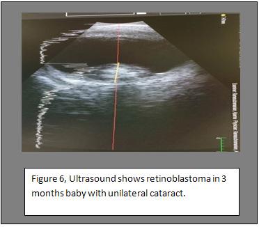 Discussion As there were no previous studies that had a similar experience (the role of ultrasound in infants who were suspected to have congenital cataract), we share our experience in highlighting