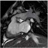 Supravalvular Complex stenosis with pulmonary previous surgical disease