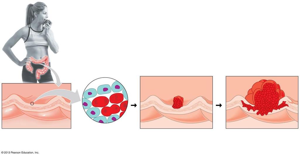 Multistep Nature of Cancer Cellular changes: Increased cell division Cellular changes: Growth of benign tumor Cellular changes: Growth of malignant tumor