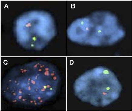 FISH analysis in neuroepithelial tumors. (A, B) Two separate hybridizations identify the co-deletion of 1p36 and 19q in oligodendroglioma on the same tissue section.