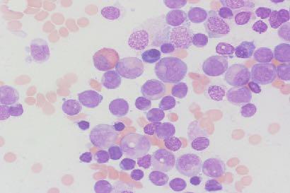 t(8;21) in AML Identified by Dr. Janet D. Rowley in 1973 as the first recurring translocation in acute leukemia. Associated with AML-M2 (~30% of AML-M2 cases, or ~5-10% of all AML).