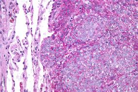 Ewing s sarcoma with the characteristic t(11;22)(q24;q12)