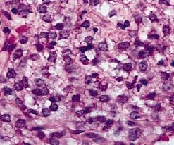 Myxoid/round cell liposarcoma