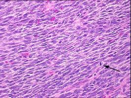 Synovial sarcoma with t(x;18)(p11.