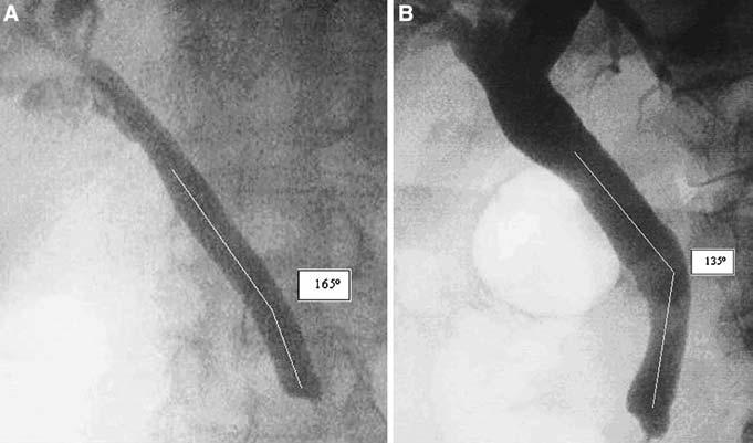 1596 Fig. 1. A A straight common bile duct. B An unangulated common bile duct. Table 1.
