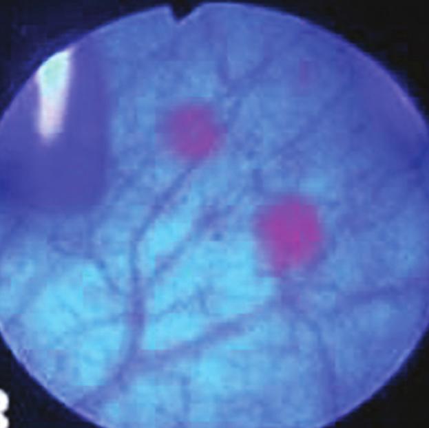 A cystoscopy can also use blue light with Cysview Your doctor also has the option of enhancing a cystoscopy by adding blue light and Cysview to the procedure.