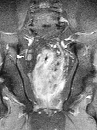 Two cases of colorectal cancer were demonstrated by the preoperative MR study and confirmed by the follow-up CT. However, they were not detected in the preoperative CT images.