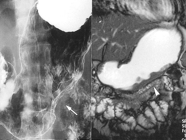 MRI in GI malignancies 273 tiate from adenocarcinoma in routine axial abdominal CT.