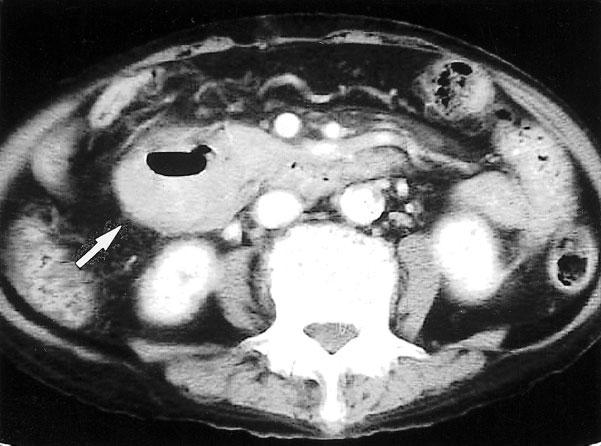 Nevertheless, many cases in our study showed that Figure 4. A 33 y/o female with advanced gastric cancer.