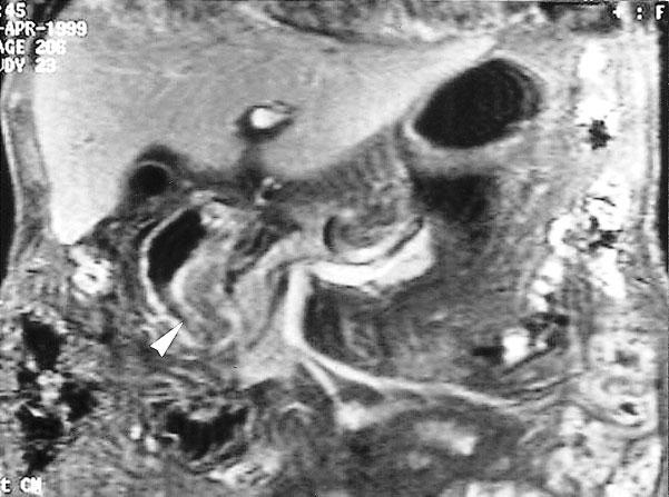 Right: Coronal True-FISP MR imaging showed the lesion and a clear interface with the other adjacent intestinal loops (arrowhead). No extraserosal invasion was found after operation.