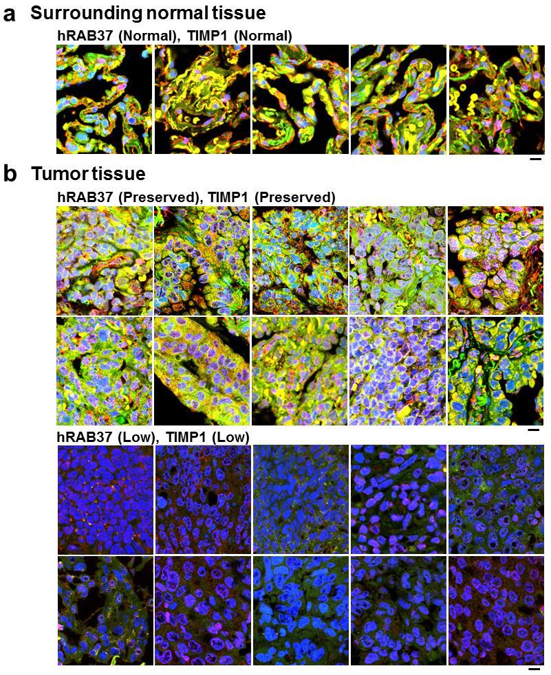 Supplementary Figure 11. hrab37 correlates with TIMP1 expression in lung cancer patients.