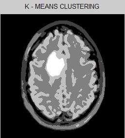 Tumor Fig -7: K-Means Clustering