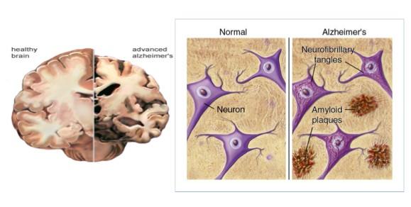 Alzheimer s Disease (AD) Mouse models: APP/PS1, PS1δE9, APPswe,