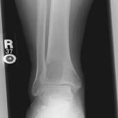 Figure 5 27. You are shown an AP radiograph (Figure 5) of the ankle of a 35-year-old man. What is the MOST LIKELY diagnosis? A. Osteosarcoma B. Chondroblastoma C. Osteoblastoma D.
