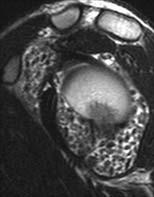 images with fat suppression. What is the MOST LIKELY diagnosis? A.